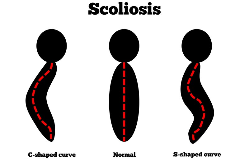 Kettering, OH scoliosis treatment